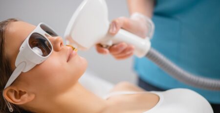 epilazione laser viso